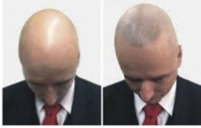 Special Feature Managing Hair Loss Aesthetics Figure 4 Before And After Two Sessions Of Hair Follicle Stimulation Over Four Weeks Images Courtesy Natasha Borciani